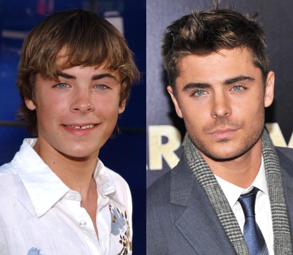 zac-efron-before-and-after