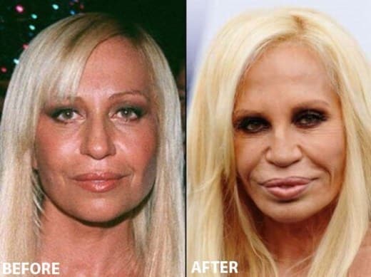 donatella-versace-plastic-surgery