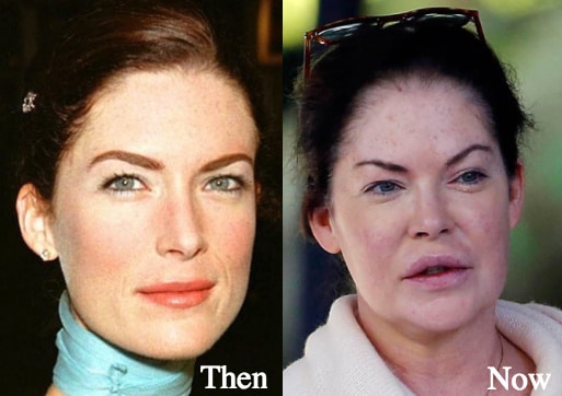 lara-flynn-boyle-plastic-surgery-before-and-after-photos