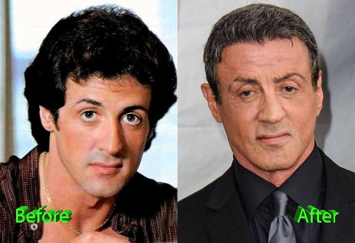 sylvester-stallone-plastic-surgery-before-and-after