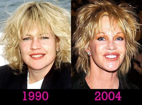 melanie-griffith-plastic-surgery-disaster