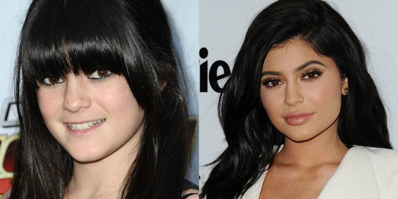 kylie-jenner-plastic-surgery-collage