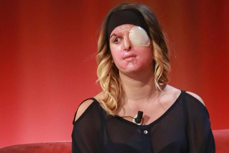 La Miss italiana Gessica Notaro muestra públicamente su rostro desfigurado tras la agresión de su ex novio