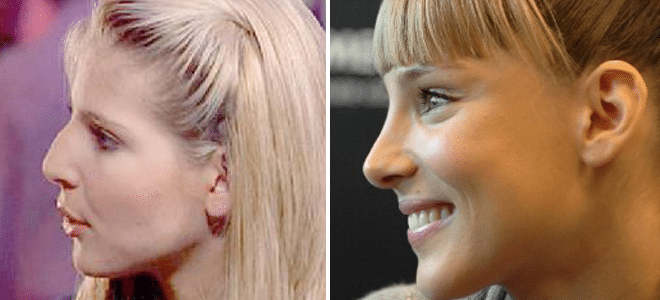Celebrities que han logrado un rotundo éxito profesional tras someterse a una rinoplastia