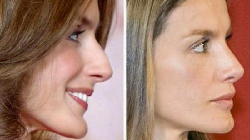 Existe preocupación en Zarzuela por la adicción de la reina Letizia a la belleza