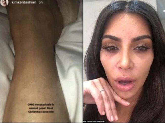 Kim Kardashian muestra su psoriasis.