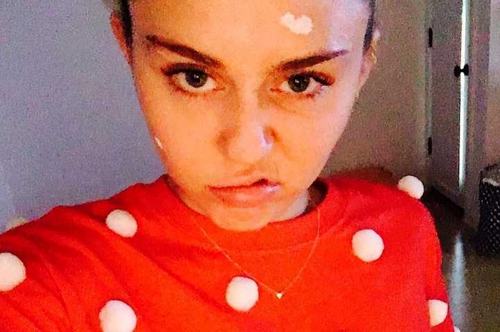 Miley Cyrus con acné severo.
