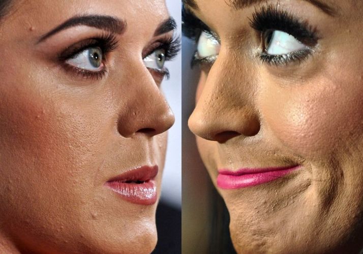 Katy Perry con acné.