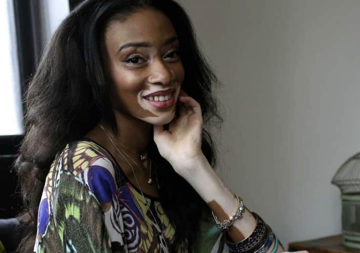 Winnie Harlow.