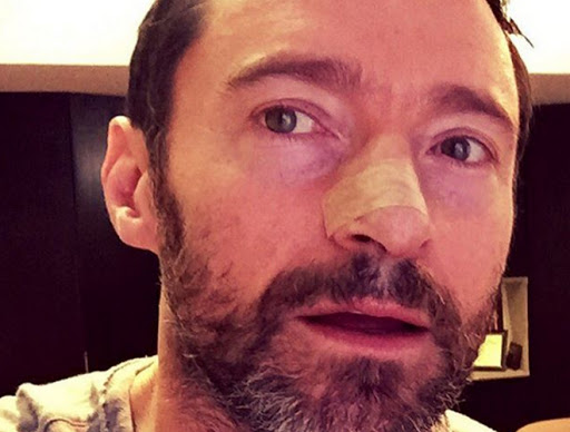 Hugh Jackman, Kim Kardashian y otros famosos con problemas de piel