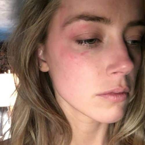 Johnny Depp: secretos develados del juicio con Amber Heard Amber Head con agresiones físicas en su rostro