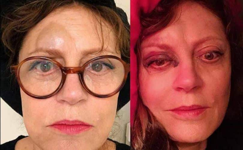¡Son humanos! Reese Witherspoon, David Beckham, Halle Berry y otros famosos que han aparecido heridos de verdad Susan Sarandon