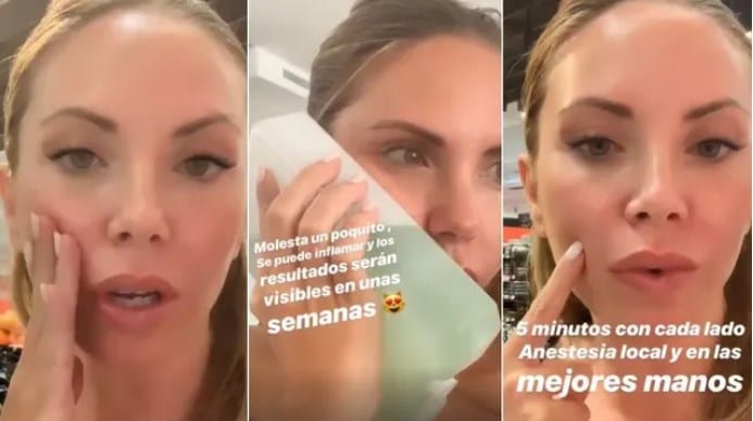 Elena Milla, adelgaza su rostro con una operación de estética