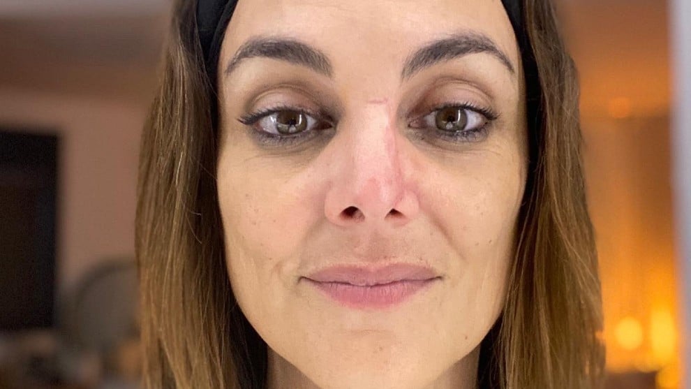 Mónica Carillo muestra su cáncer de piel 