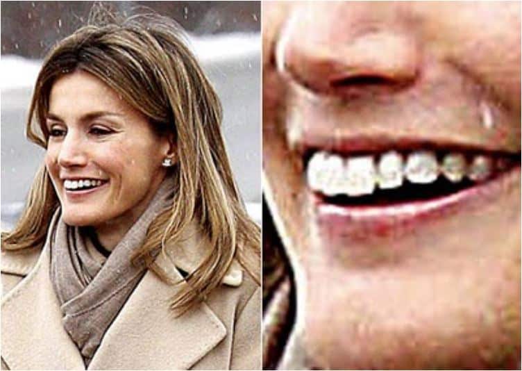 letizia dientes dentadura aparato  brackets operaciones