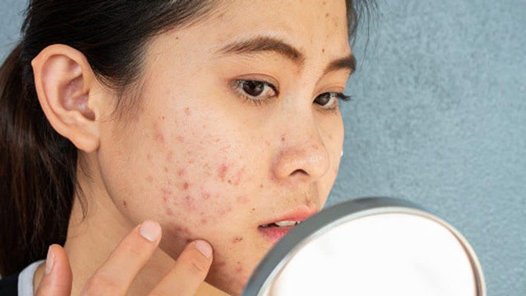 Este es el mejor tratamiento casero para eliminar el acné