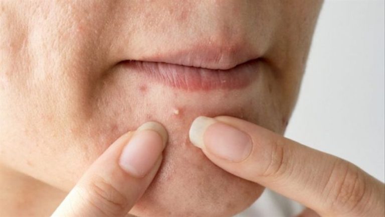 Acné: cómo quitarte un grano y que no te deje marca