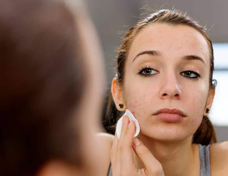 Mal uso del maquillaje provoca acné