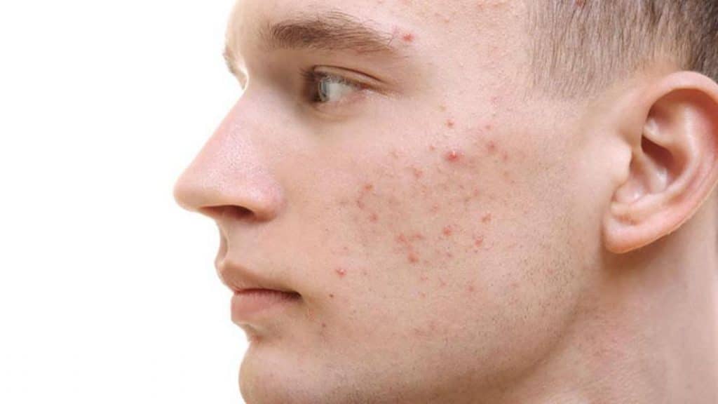 Causas del acné quístico