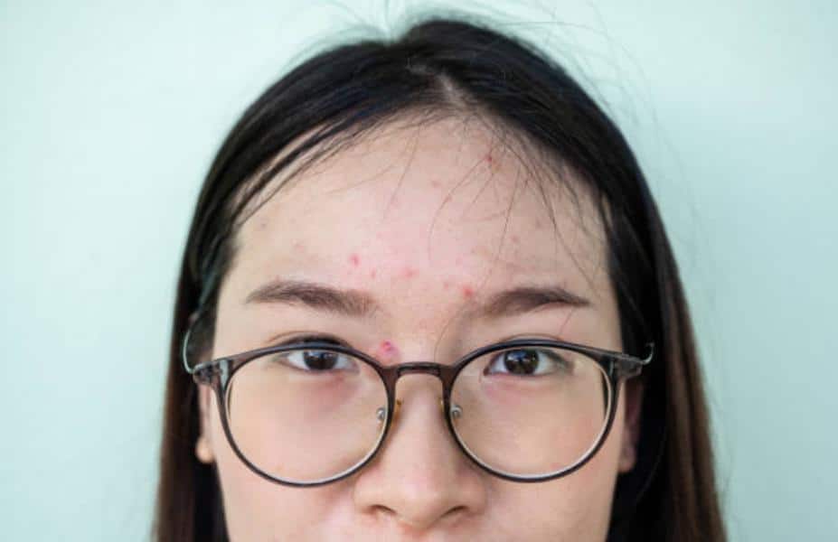 Qué es el acné quístico