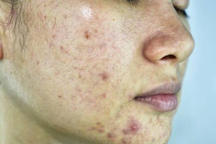 El tratamiento para eliminar el acné quístico