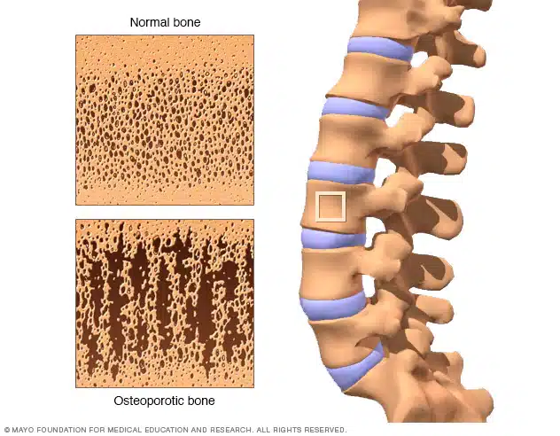 Cómo evitar la osteoporosis y tener unos huesos fuertes