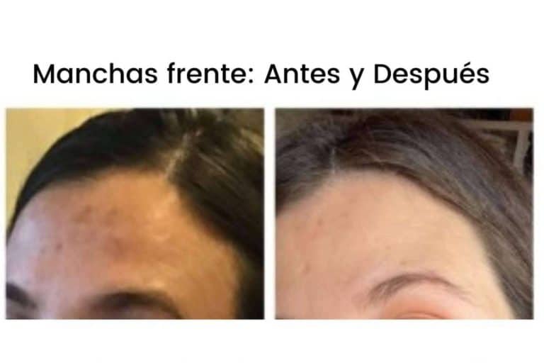 Tratamiento skincare con despigmentante facial para después del verano