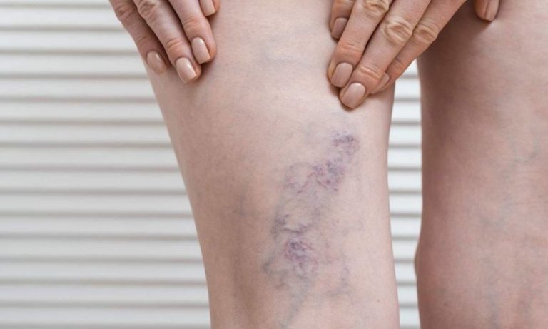 ¡Adiós a las varices! Descubre cómo combatirlas y lucir piernas saludables