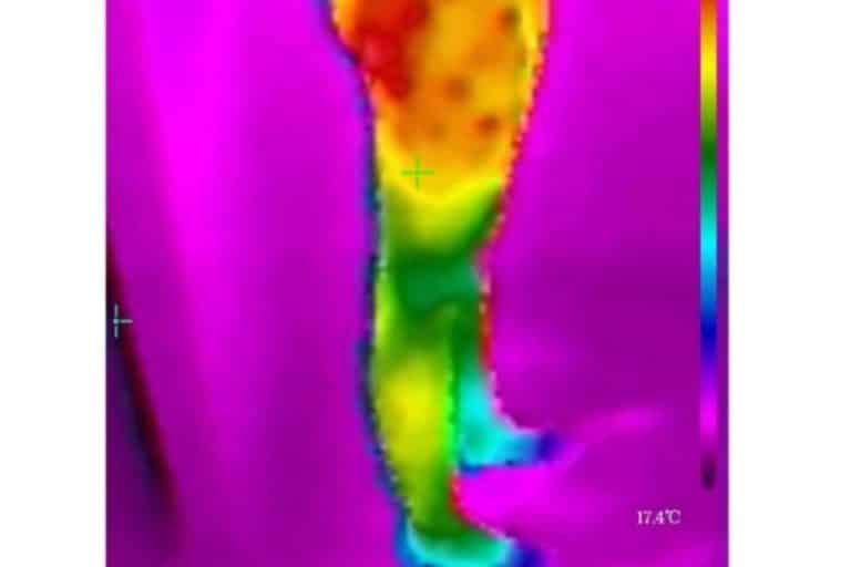 Saber cuál es la tipología de celulitis con la cámara termográfica es posible