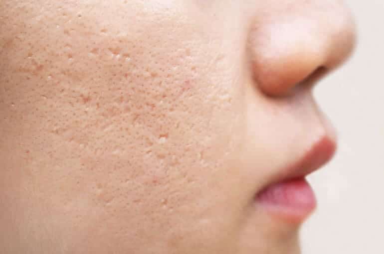 Despídete de las imperfecciones cutáneas con el innovador tratamiento de belleza de Amelia Bono. ¡Descubre la transformación!