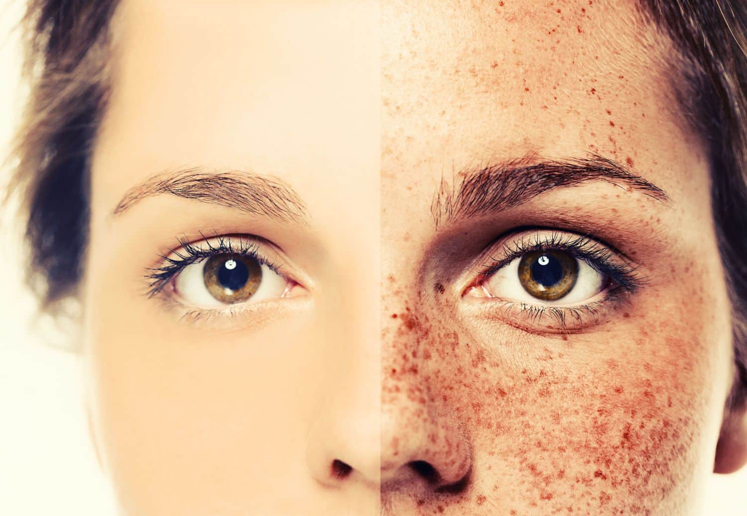 Mitos sobre el melasma: Desvelando la verdad