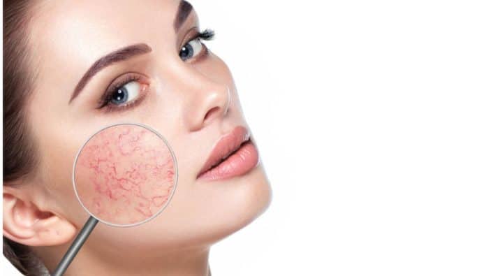 Piel roja: ¿Rosácea, dermatitis o alergias? Descubre el misterio y cómo solucionarlo