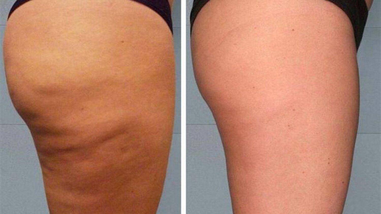 CELULITIS: CONCLUSIÓN 