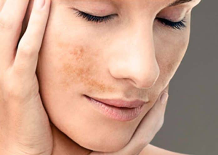 Despídete de las manchas faciales: Remedios naturales que realmente funcionan