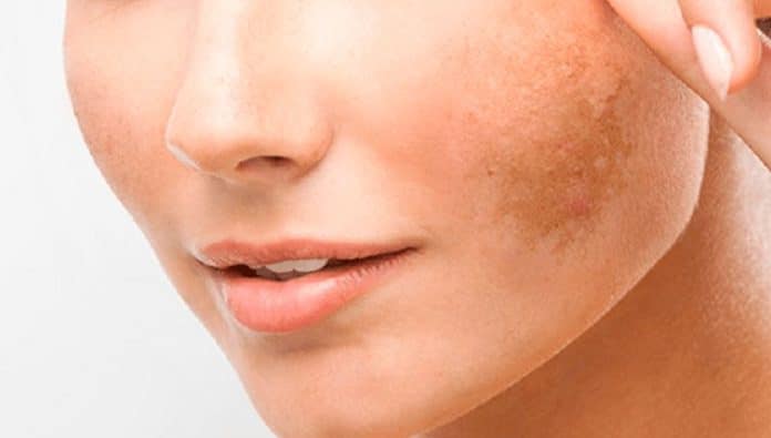 Adiós manchas faciales: Estrategias efectivas para una piel clara