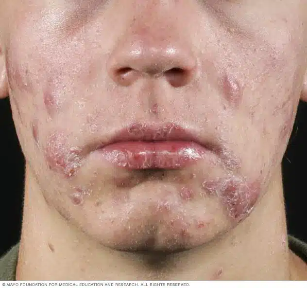 Desvelando los secretos del acné: causas, prevención y tratamiento