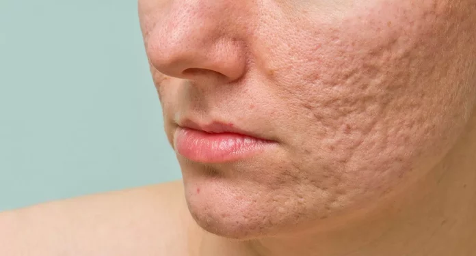 Poros dilatados: 8 tips de oro para conseguir una piel lisa y perfecta