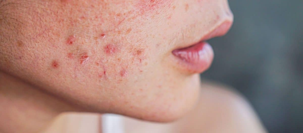 Desvelando los secretos del acné: causas, prevención y tratamiento