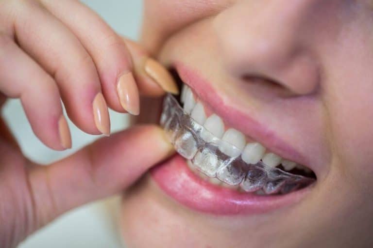7 consejos que te ayudarán a decidir entre ortodoncia invisible o brackets
