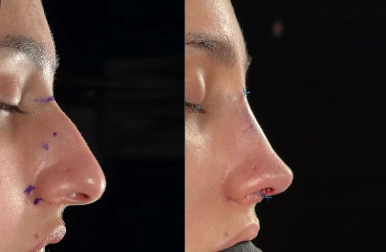 Rinoplastia: cuidados postoperatorios para una recuperación exitosa